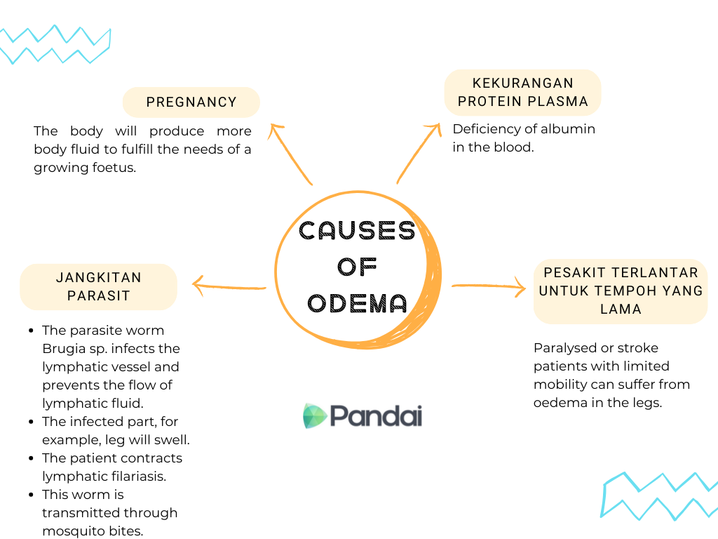 This image is an infographic titled CAUSES OF ODEMA. It is divided into four sections, each explaining a different cause of oedema. The sections are: 1. Pregnancy: The body will produce more body fluid to fulfill the needs of a growing foetus. 2. Kekurangan Protein Plasma: Deficiency of albumin in the blood. 3. Pesakit Terlantar Untuk Tempoh Yang Lama: Paralysed or stroke patients with limited mobility can suffer from oedema in the legs. 4. Jangkitan Parasit: The parasite worm Brugia sp. infects the lymphatic vessel and prevents the flow of lymphatic fluid. The infected part, for example, leg